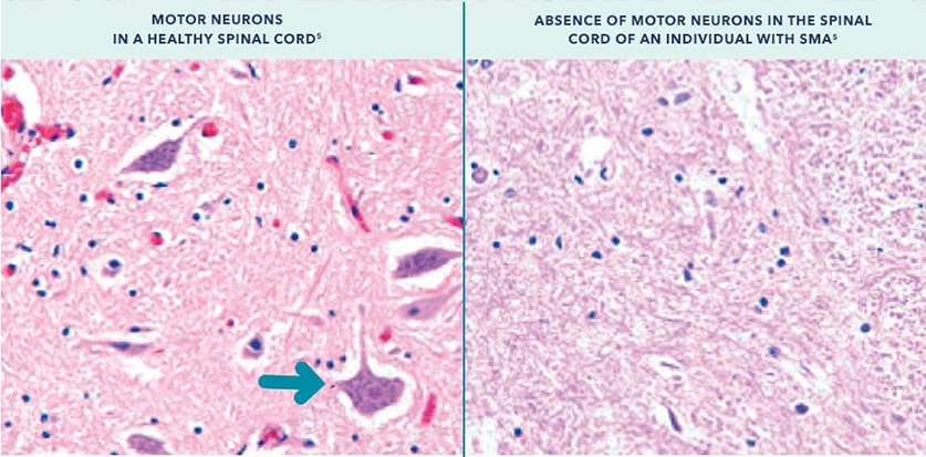 Functional, full-length SMN protein is necessary to maintain the health and function of motor neurons in the spinal cord.